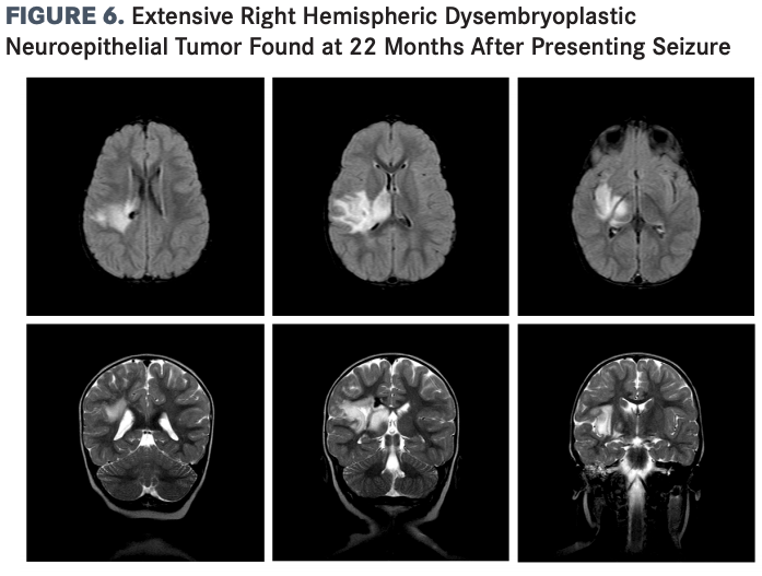 Top: Axial T2-FLAIR MRI brain images show a large right hemispheric DNET at age 22 months. 
Bottom: Coronal T2 MRI brain sequences from the same study provide an additional view of the large right hemispheric DNET, which involves the right insular structures and extends deep into the basal ganglia. 

DNET, dysembryoplastic neuroepithelial tumor; T2-FLAIR, T2-weighted fluid-attenuated inversion recovery