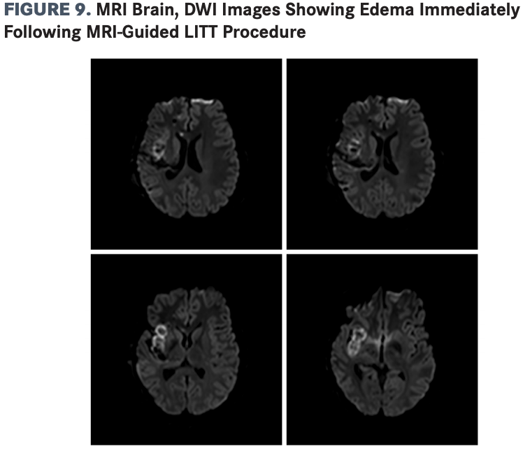 Ablation was performed in the right insular regions sampled by the AIASG, AIMSG, AIPSG, and PIALG electrodes utilizing the existing bolts and trajectories from the SEEG study. 
DWI, diffusion-weighted imaging; MRI-guided LITT, MRI-guided laser interstitial thermal therapy; SEEG, stereoelectroencephalography; AIASG, anterior insula anterior short gyrus; AIMSG, anterior insula middle short gyrus; AIPSG, anterior insula posterior short gyrus; PIALG, posterior insula anterior long gyrus