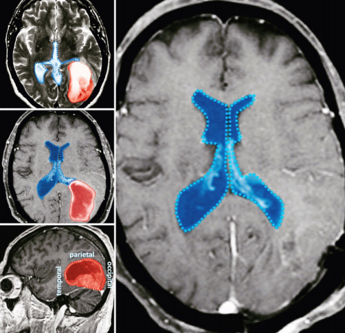 FIGURE 3. Scans of Mass in Brain. Left panels: Temporal-parietal-occipital mass. Right panel: Two weeks post-surgery.