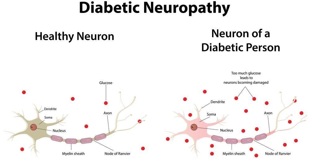 Mini Quiz: Treatment-Induced Neuropathy of Diabetes