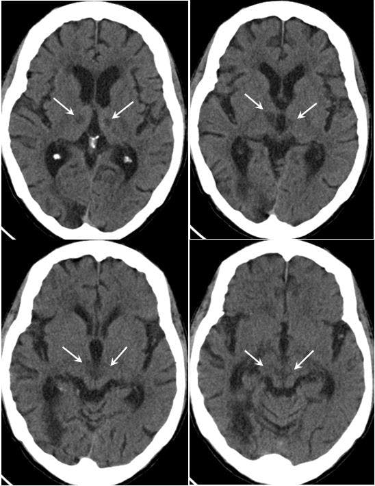 Noncontrast CT of head 