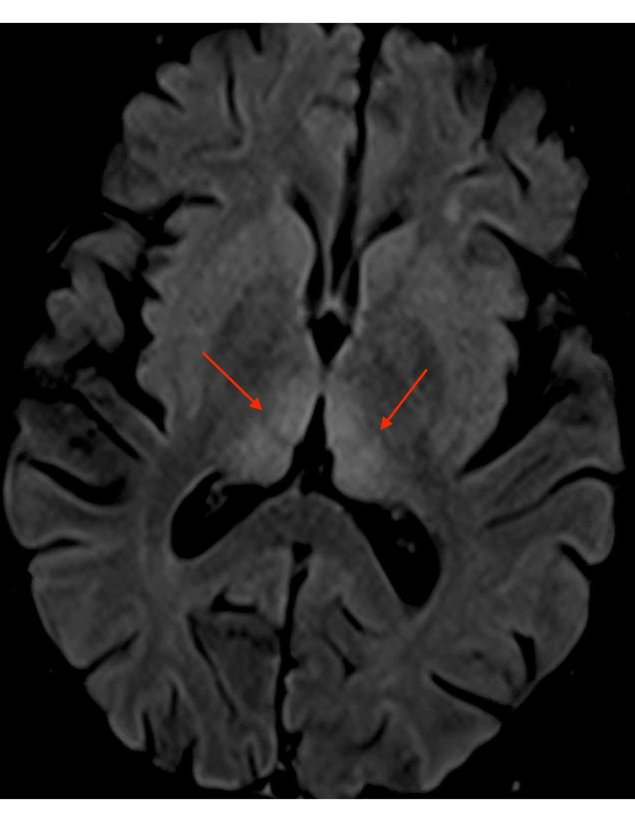 MRI brain scan axial FLAIR periaqueductal gray matter