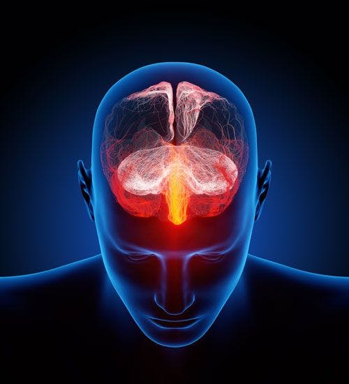 Headache Imaging Can Spot Brain Tumors