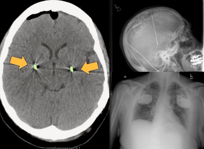FIGURE 4. Montage of a Patient With Parkinson Disease With Bilateral Globus Pallidus Internal Implants
