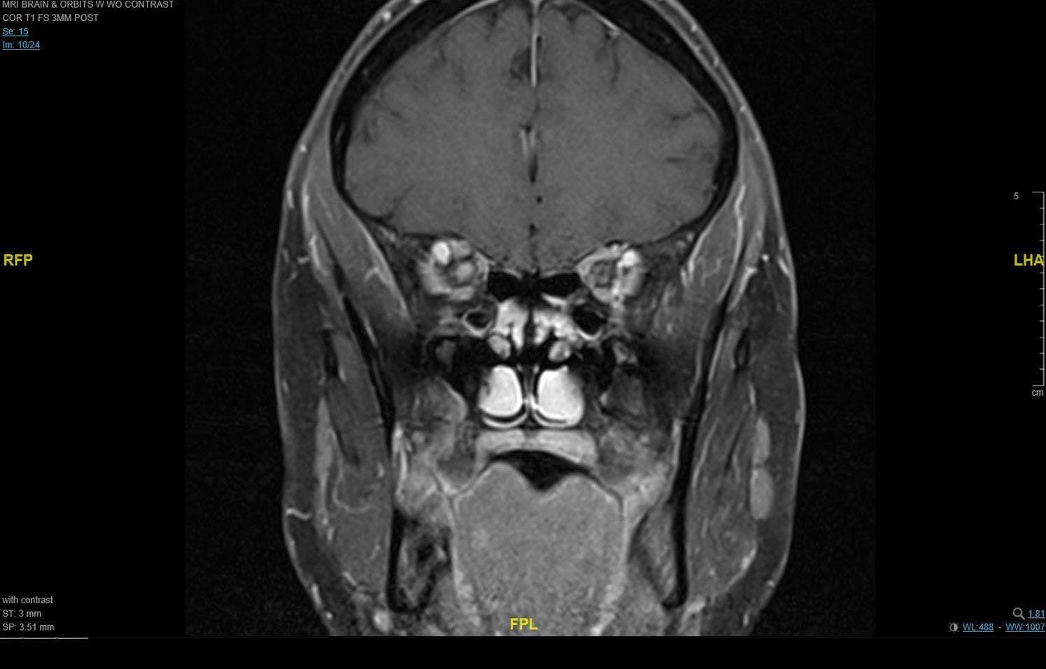 Figure 4. Brain and orbit MRI showing enhancement of the right optic nerve in a patient with optic neuritis