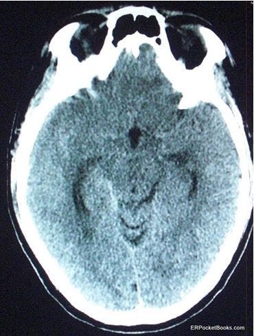 Subarachnoid hemorrhage CT scan of head 