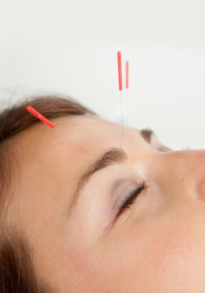 Acupuncture for Migraine