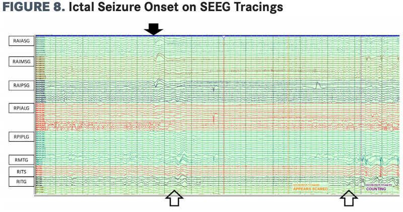 The seizure spread quickly to cortex sampled by RMTG, RITS, and RITG (open arrows) with the onset of clinical features (fear). The patient was able to count during the start of this seizure. 
SEEG, stereoelectroencephalography; RMTG, right middle temporal gyrus; RITS, right inferoro temporal sulcus; RITG, right inferior temporal gyrus.
