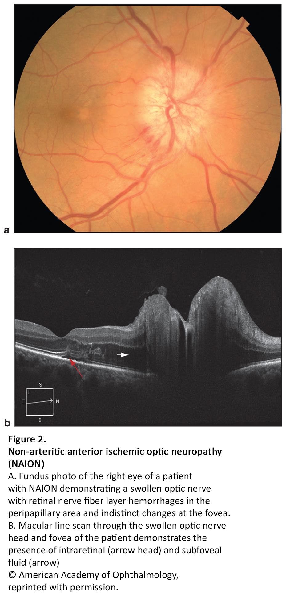Figure 2. Non-arteritic anterior ischemic optic neuropathy (NAION)