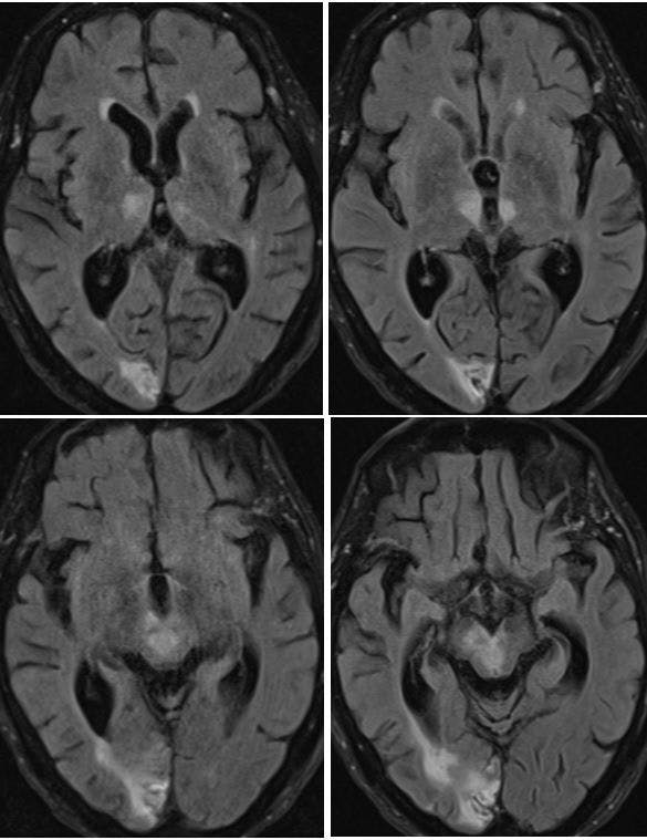 MRI of brain, axial FLAIR images