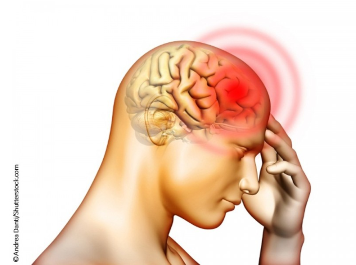 Migraine brain head pain headache