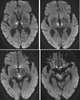 MRI of brain; axial diffusion-weighted images