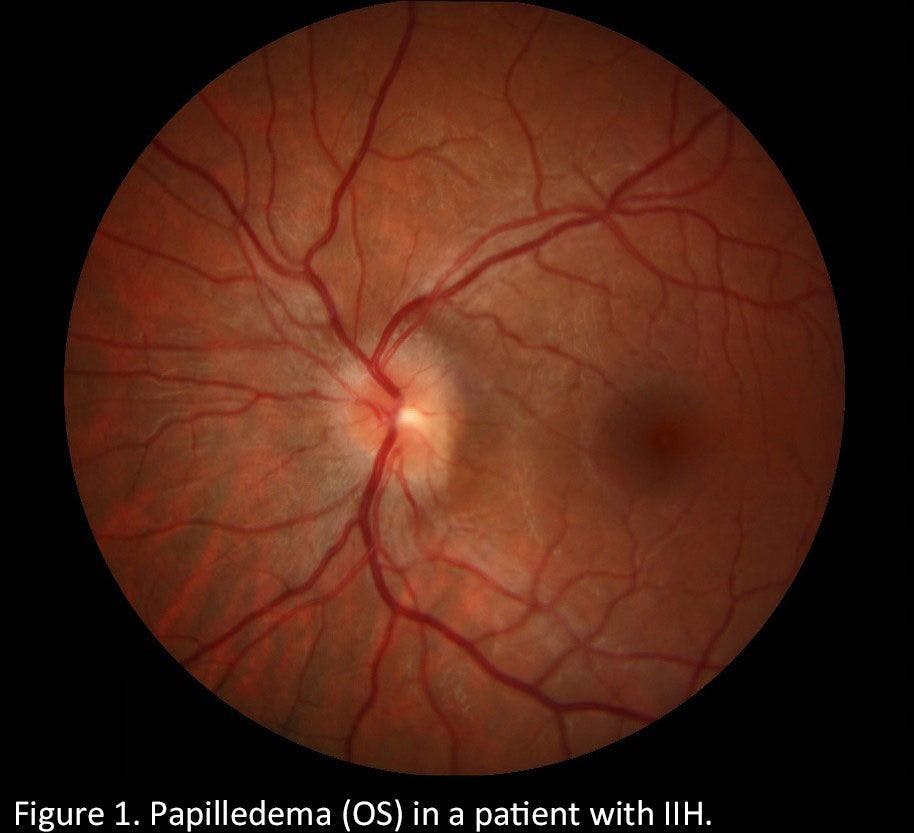 Figure 1. Papilledema (OS) in a patient with IIH