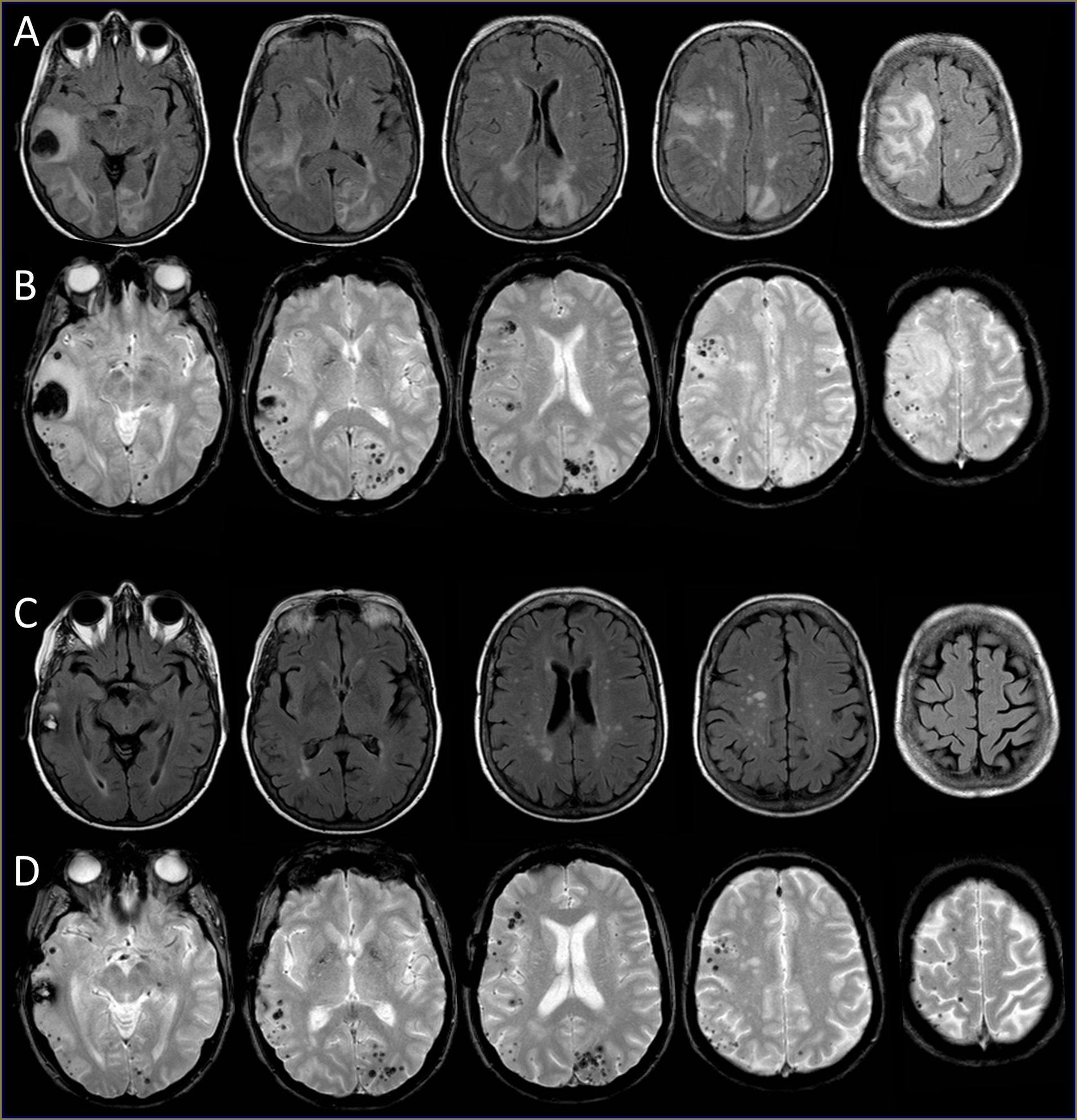 Figure 1. MRI brain pre-and post-treatment with corticosteroids