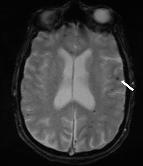 A Clinical Update of Intracerebral Hemorrhage