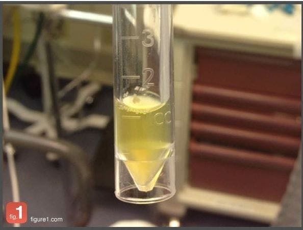 Yellow Cerebrospinal Fluid