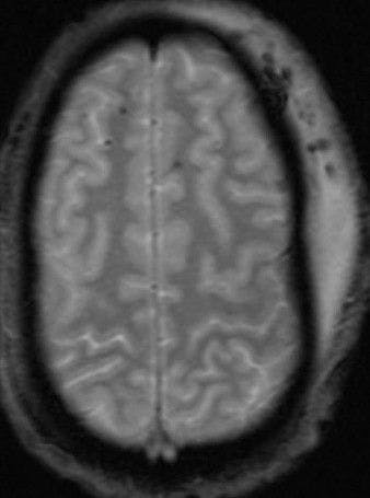 MRI T2 GRE scan trauma brain injury scalp hematoma