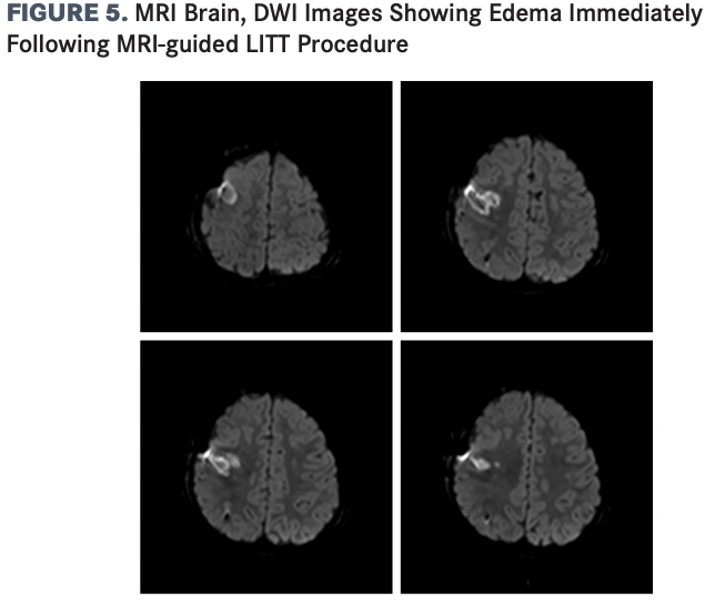 The RIMFG and RMFGc electrodes were removed and replaced by a laser catheter using the same bolts and trajectories to target the epileptogenic cortical tuber in the right prefrontal region. 

DWI, diffusion-weighted imaging; MRI-guided LITT, MRI-guided laser interstitial thermal therapy, RIMFG, right intermediate middle frontal gyrus.