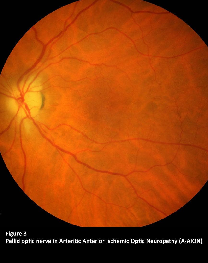 Figure 3. Pallid optic nerve in anterior ischemic optic neuropathy (A-AION)