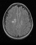MRI FLAIR suggestive of multiple sclerosis. http://radiopaedia.org
