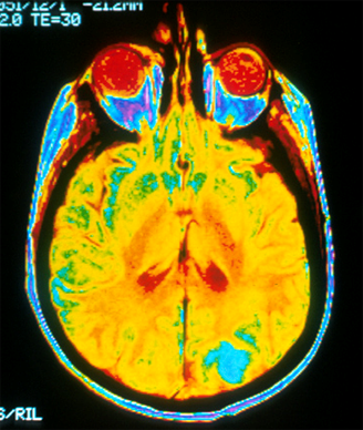 MRI May ID Hard-to-tell-apart Brain Diseases