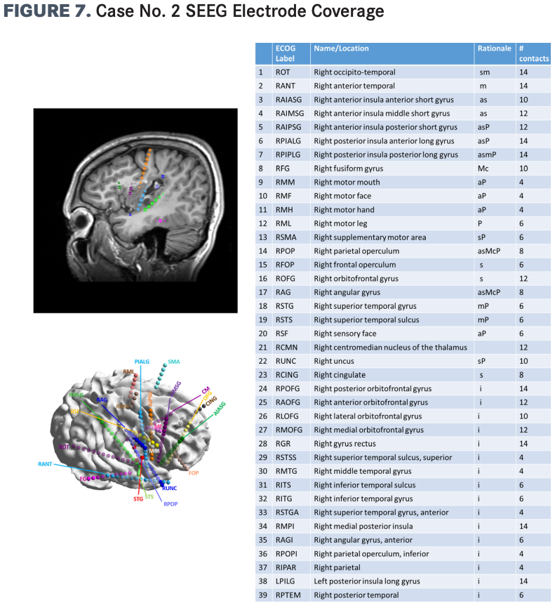 Right: List of 39 electrodes sampling multiple right hemispheric regions and the left posterior insular long gyrus based on the following rationale: s: semiology; m: MEG; a: anatomy; P: FDG-PET; Mc: MEG cluster; i: scalp ictal/interictal EEG. 
Left, top: Reconstruction of 5 right insular electrodes superimposed on sagittal MRI brain images. Dark green: RAIASG; purple: RAIMSG; orange: RAIPSG; blue: RPIALG; bright green: RPLIPG. 
Left, bottom: Three-dimensional model of SEEG electrode placement. 

EEG, electroencephalogram; FDG-PET, fluorodeoxyglucose F 18 positron emission tomography; MEG, magnetoencephalography; SEEG, stereoelectroencephalography. 

Images reprinted with permission from Kimberly Houck, MD.