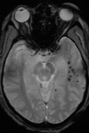 MRI T2 GRE scan traumatic brain injury