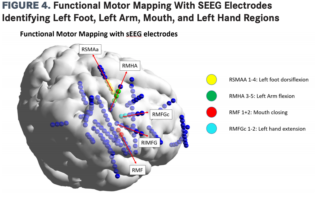 SEEG, stereoelectroencephalography. 

Image reprinted with permission from Cemal Karakas, MD.
